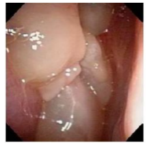 多発する鼻ポリープ