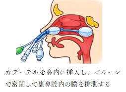 ヤミックカテーテル療法2
